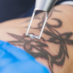 Tattoo Removal CU_1600x900